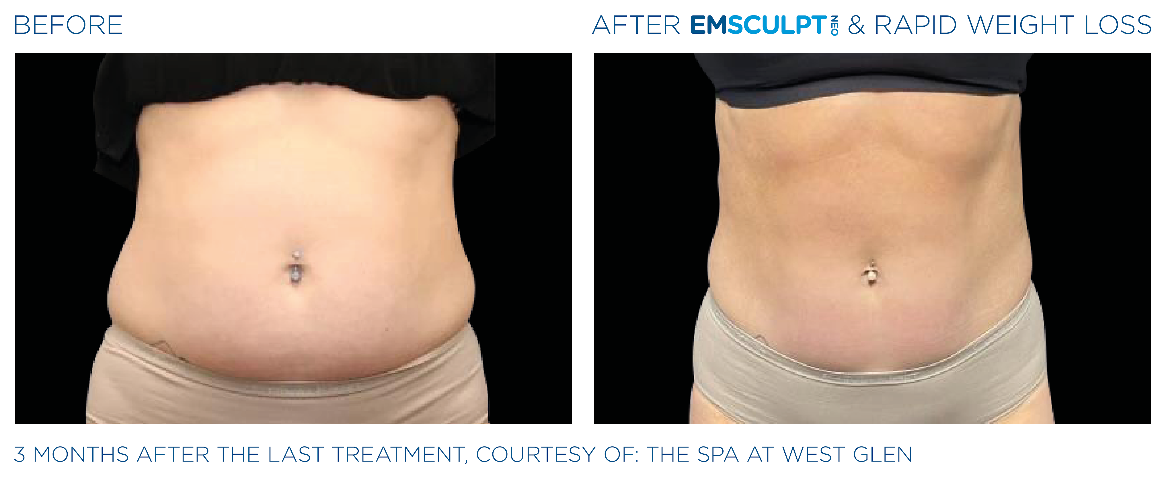 Unmodified BTL Aesthetics female abdomen comparison after EMSCULPT NEO® and rapid weight loss
