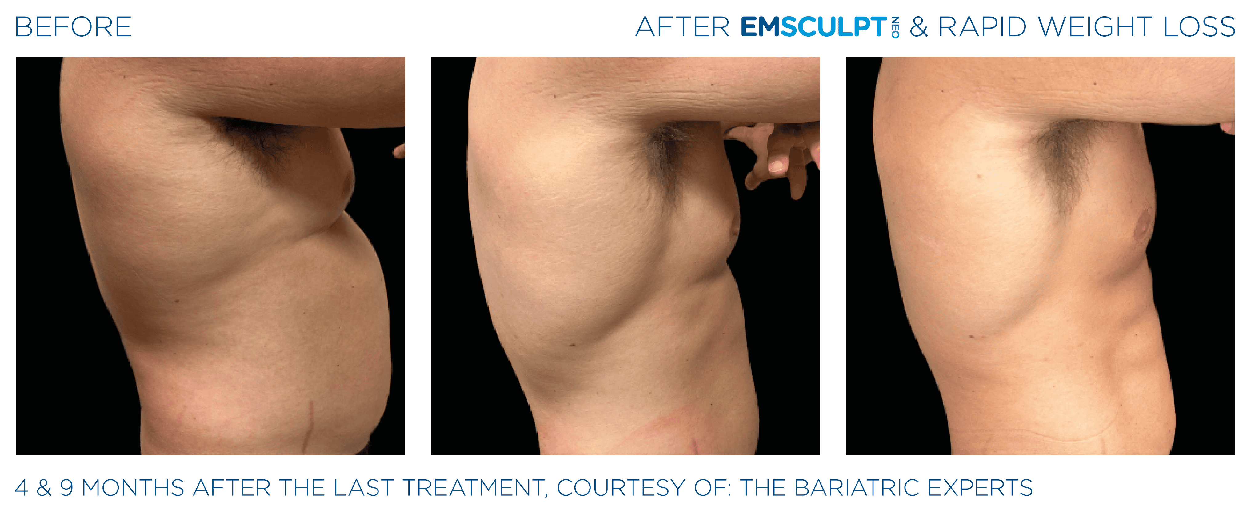 Unmodified BTL Aesthetics male abdomen comparison